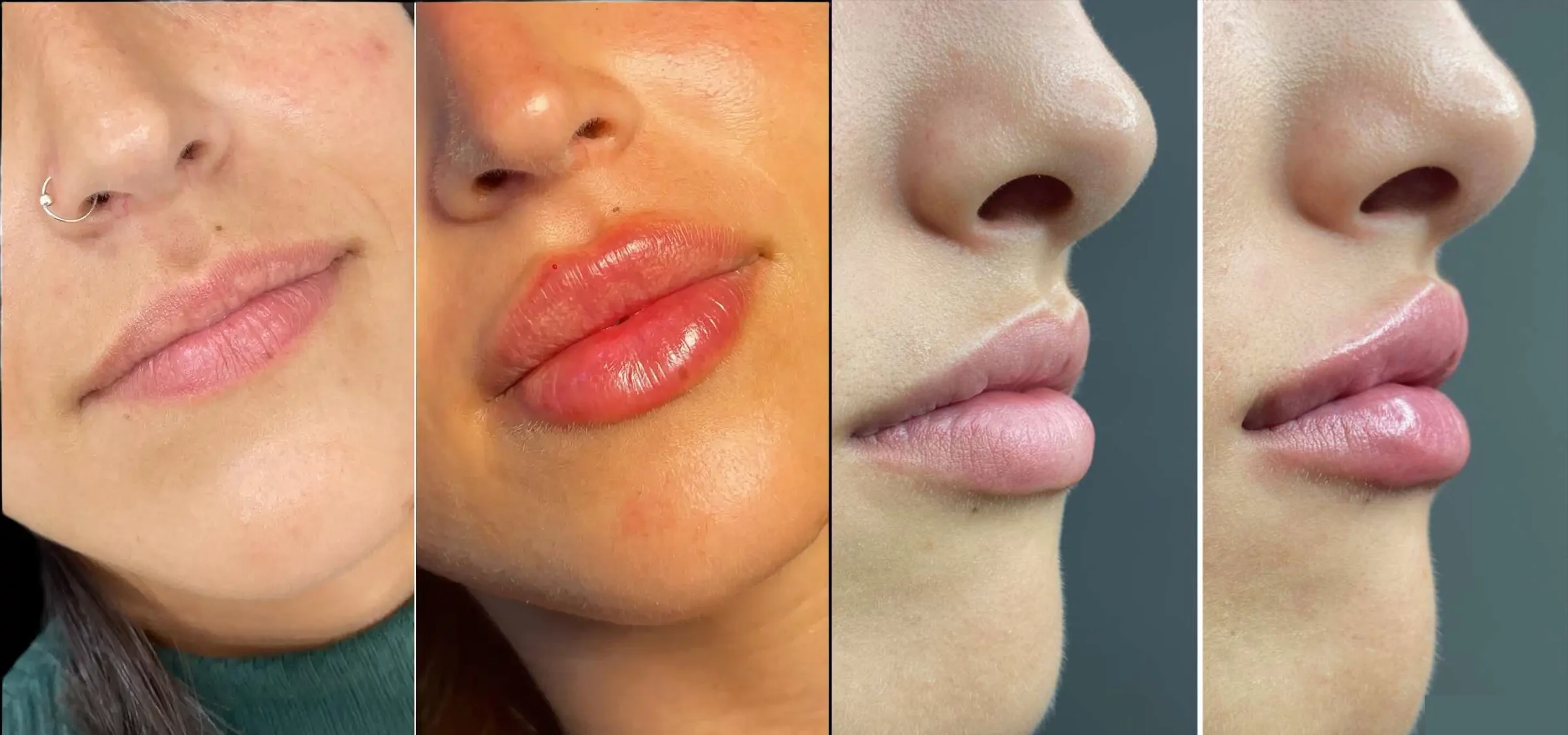 بهترین دکتر تزریق ژل لب عروسکی در مشهد