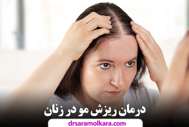 درمان ریزش مو در زنان